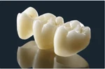 Crown & Bridge Dental Lab All-ceramic Pfm Full Cast. Fixed Price $319.00.